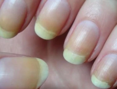 Κίτρινα νύχια; - Δείτε ποια ασθένεια μπορεί να κρύβεται «κάτω» από το χρώμα των νυχιών σας